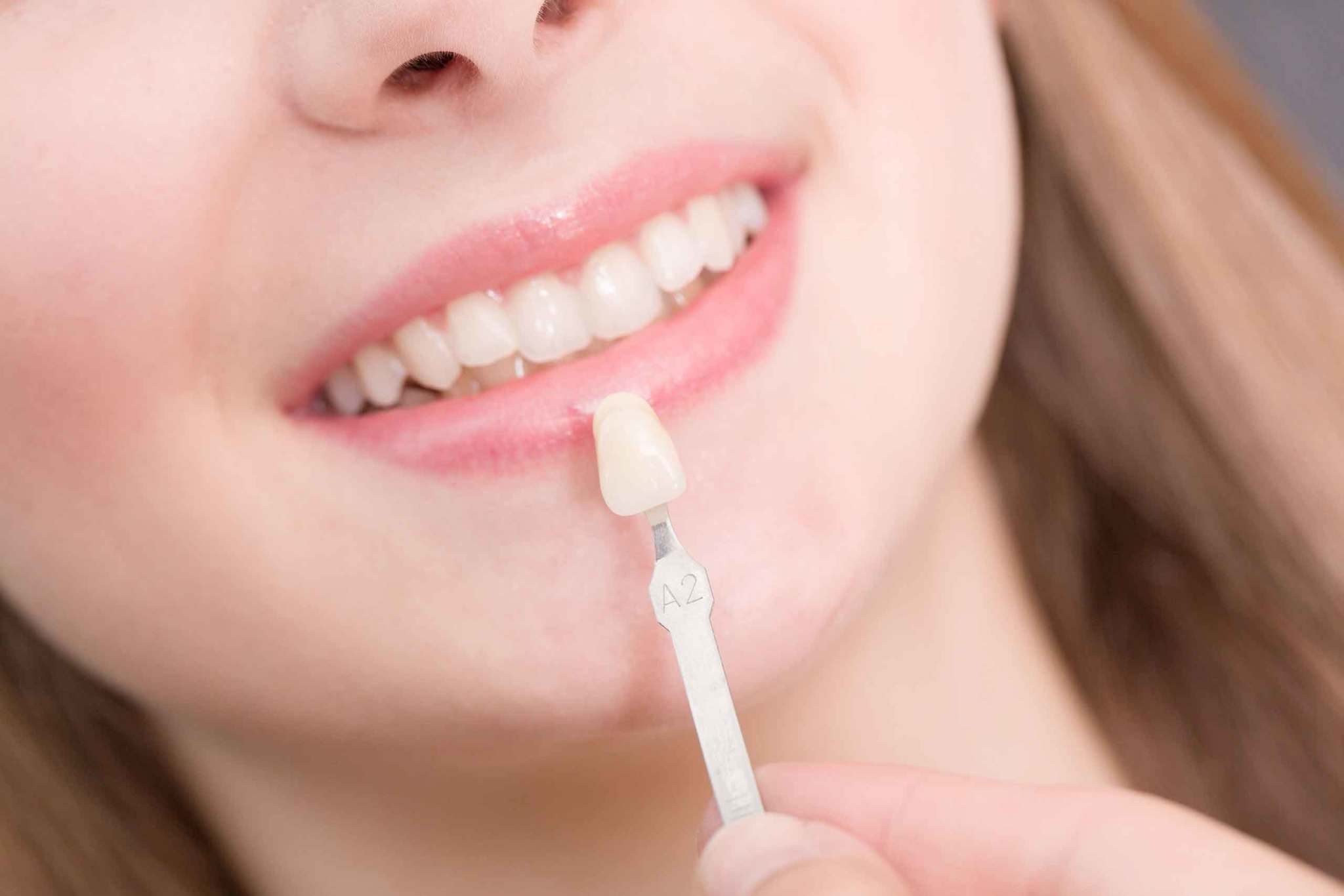 Porcelain Veneers